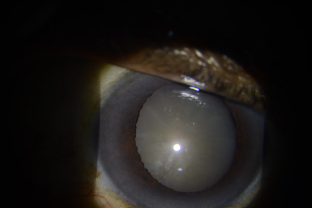 Cataract - cortical cataract
