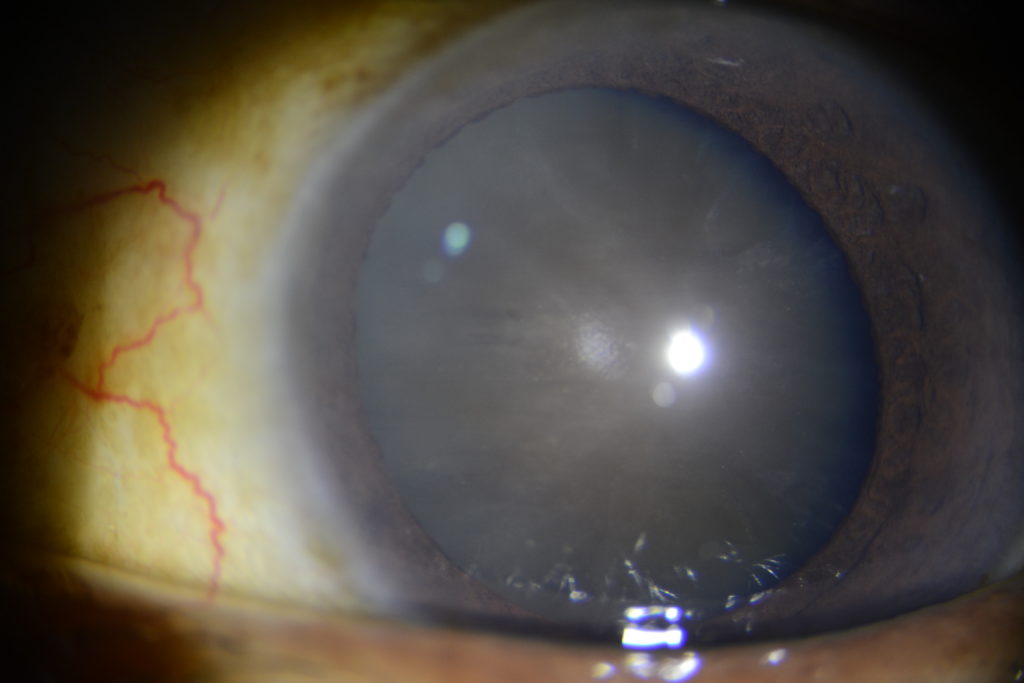 Cataract - hard cataract nuclear type