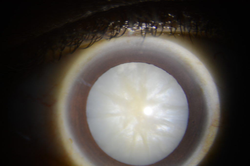 Cataract - mature cataract